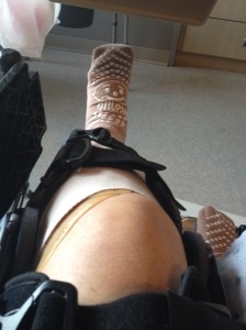 My broken leg, in a brace, covered with bandages. But, look, my socks are smiling. 